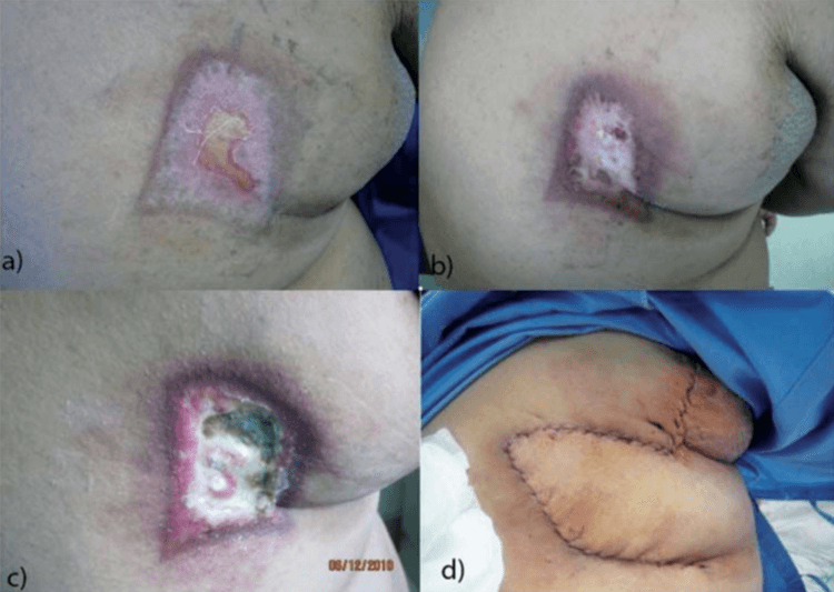Reducing Peak Skin Dose on patients undergoing interventional procedures