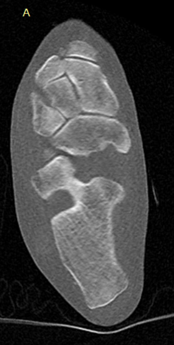 low dose ct
